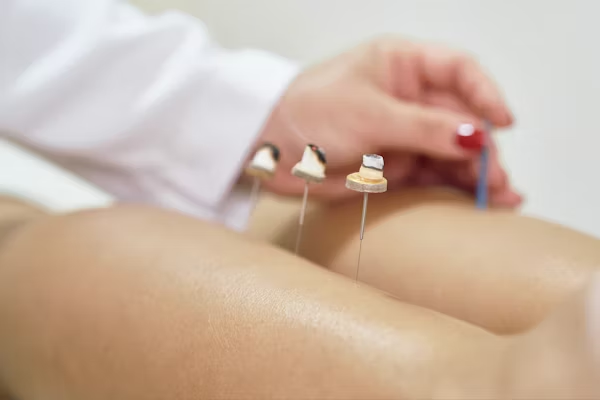 Acupuncture treatment with needles inserted into a person's back.