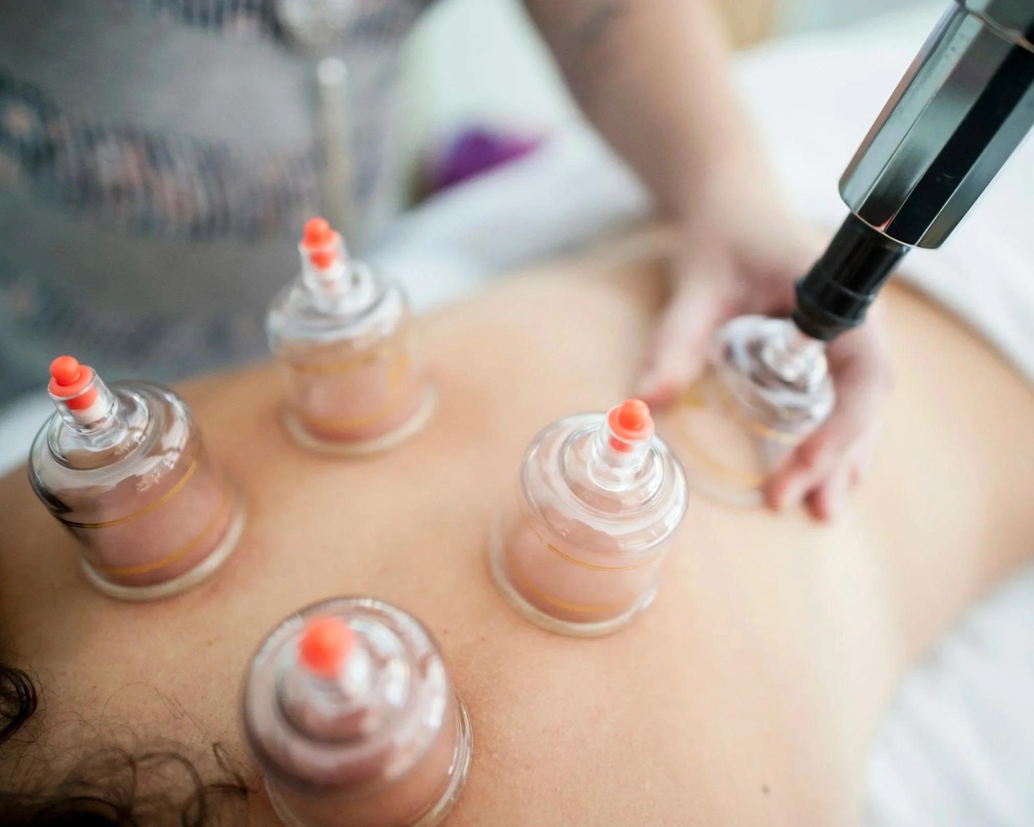 Close-up view of multiple syringes arranged on a person's skin, with someone holding a small glass vial connected to a syringe.