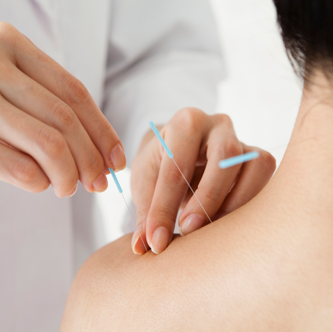 Person receiving acupuncture treatment with thin needles inserted into their shoulder