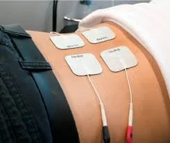 Four adhesive electrodes attached to a person's lower back, connected by wires to medical monitoring equipment.