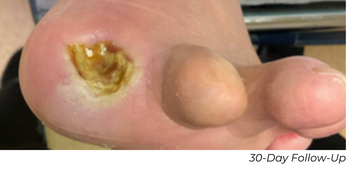 Clinical photograph showing wound healing progress at 30-day follow-up in Patient A case study