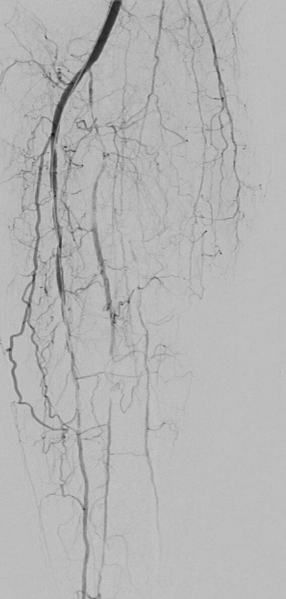 Angiographic image showing pre-intervention anterior tibial artery occlusion, Figure 2A, Dr. Bradley Trinidad case study