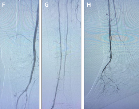 Angiographic images showing tibial artery and foot vasculature after Serranator serration angioplasty with significant luminal gain, no recoil, and brisk distal flow