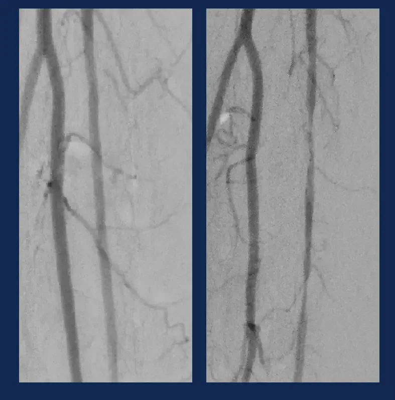 Angiographic images of POBA-treated tibial artery immediately post-procedure and 15 minutes later demonstrating recoil