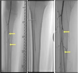 Angiographic images showing Tibial Peroneal Trunk lesion with 100% stenosis treated with Serranator achieving 22% residual stenosis with no dissection