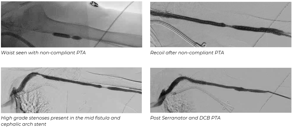 Fistulagram images showing non-compliant balloon waist and recoil, high-grade stenoses in mid fistula and cephalic arch stent, and resolution following Serranator and DCB angioplasty