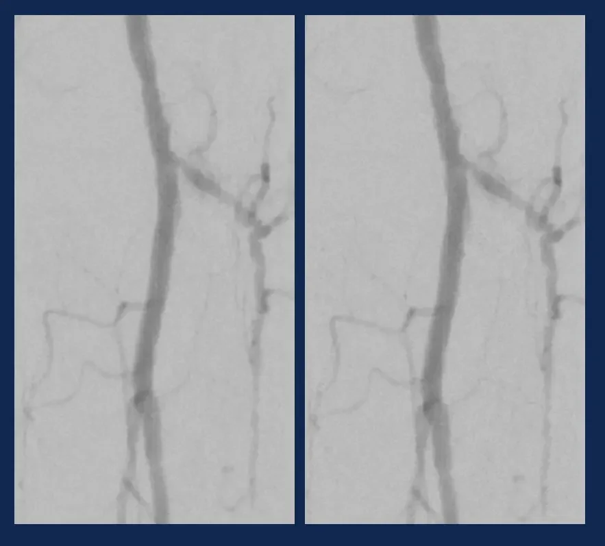Angiographic images of Serranator-treated tibial artery immediately post-procedure and 15 minutes later showing minimal to no recoil