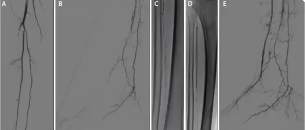 Angiographic images showing SAFARI technique recanalization of anterior tibial artery occlusion from diagnosis through Serranator balloon treatment to completion perfusion, Figures A–E