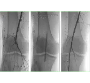Angiographic sequence showing total occlusion of right proximal popliteal artery treated with Serranator, reducing stenosis from 100% to 20.23%