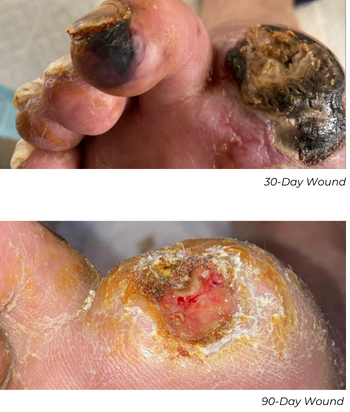 Clinical photograph showing wound healing progress at 30-day and 60-day follow-up in Patient D case study