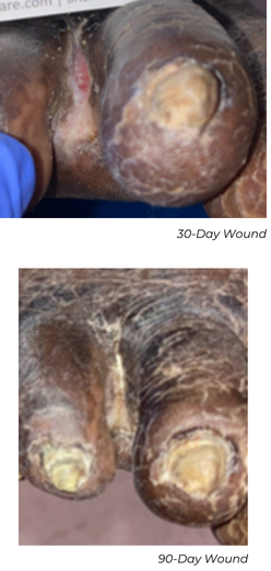 Clinical photograph showing wound healing progress at 30-day and 90 day follow-up in Patient C case study