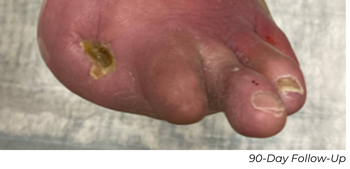 Clinical photograph showing nearly healed wound at 90-day follow-up in Patient A case study