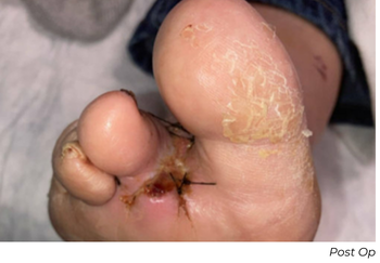 Clinical photograph showing foot post-procedure following Serranator Remodeling Therapy in Patient B case study