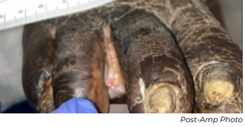 Clinical photograph showing post-amputation great toe wound in Patient C case study