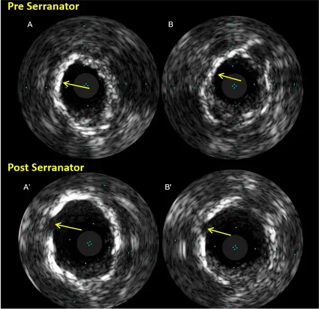IVUS images showing diffuse circumferential calcification before Serranator treatment and resulting slits enabling lumen enlargement without dissection, per Dr. Akiko Maehara