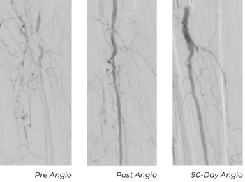 Angiographic images showing pre-treatment, post-treatment, and 90-day views of tibioperoneal trunk after Serranator and DCB treatment in Patient D case study
