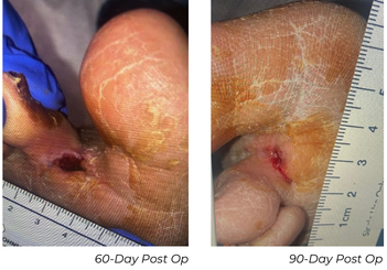 Clinical photographs showing wound healing progress at 60-day and 90-day follow-up in Patient B case study