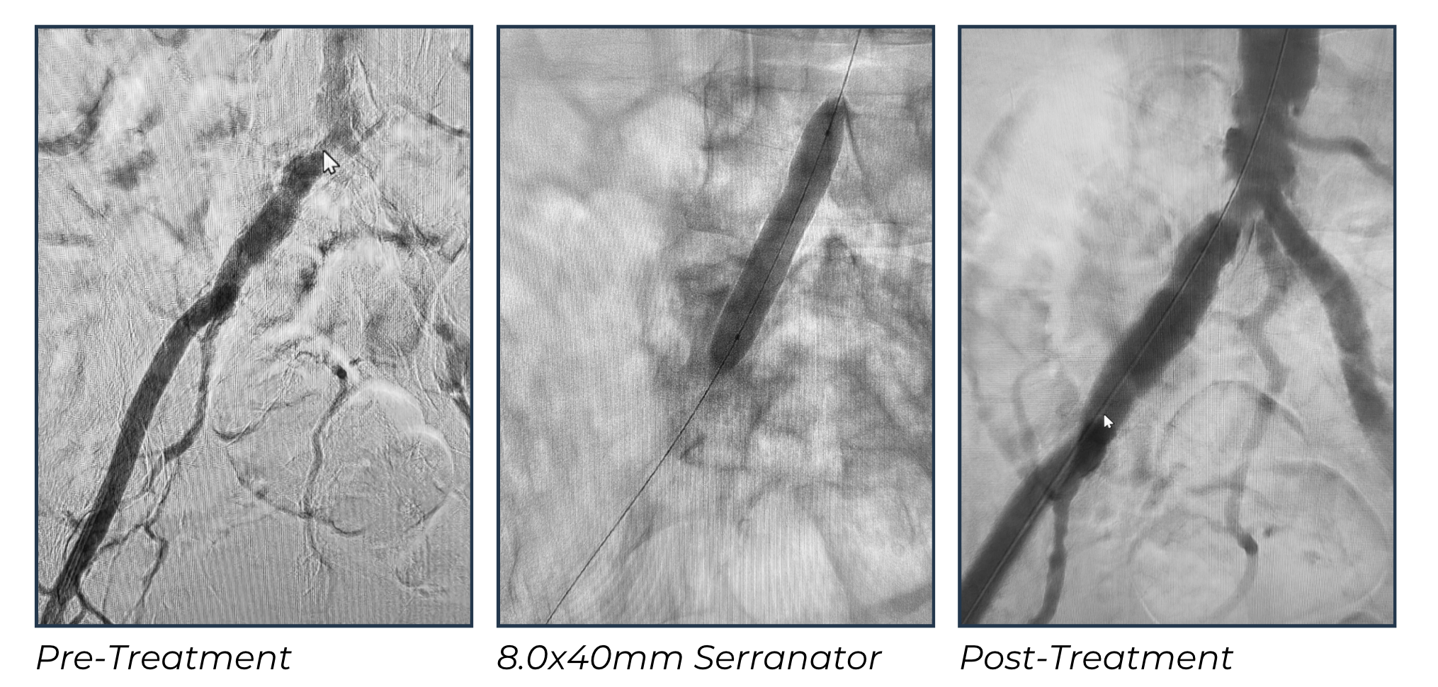 Angiographic images showing pre-treatment severe right common iliac bifurcation stenosis, 8.0x40mm Serranator inflation, and post-treatment resolution without stenting
