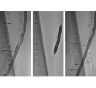 Angiographic sequence showing severely calcified right distal SFA lesion treated with Serranator, reducing stenosis from 94.59% to 24.07%