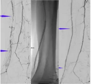Angiographic images showing Distal Anterior Tibial lesion with 100% stenosis treated with Serranator achieving 15% residual stenosis with no dissection