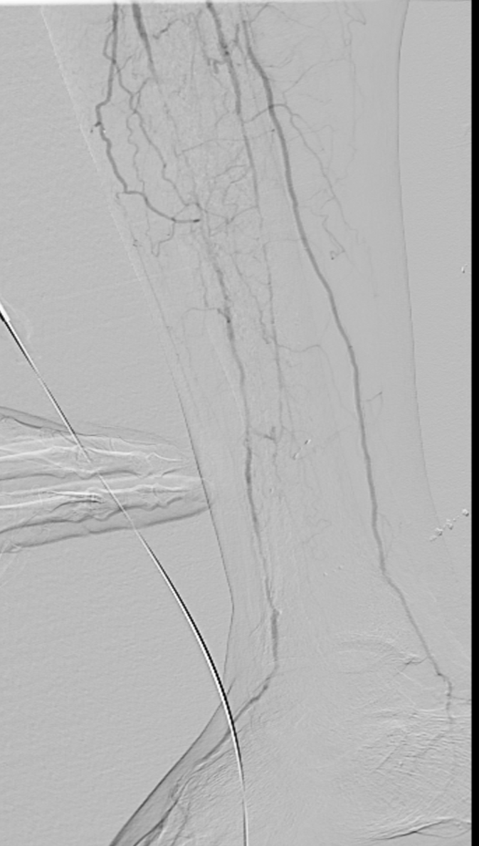 Angiographic image showing pre-intervention dorsalis pedis artery occlusion, Figure 2B, Dr. Bradley Trinidad case study