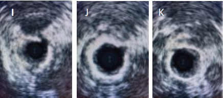 Intravascular ultrasound images showing open tibial artery lumen with visible serrations into calcified medial vessel wall following Serranator treatment