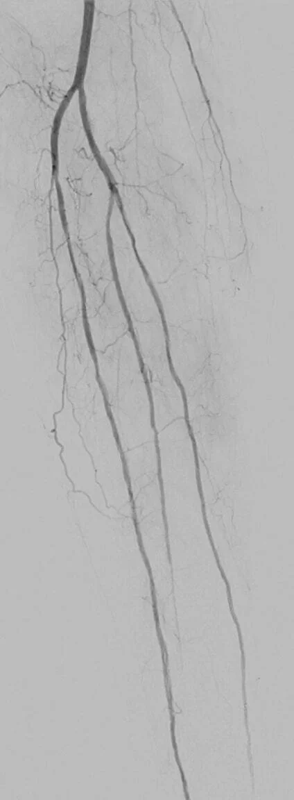 Angiographic image showing posterior tibial artery and tibioperoneal trunk after directional atherectomy and OCT-guided Serranator angioplasty