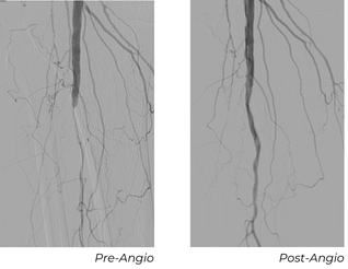 Angiographic images showing pre-treatment, post-treatment, and 90-day views of tibioperoneal trunk after Serranator and DCB treatment in Patient C case study
