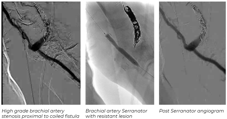 Angiographic images showing high-grade brachial artery stenosis proximal to coiled fistula, Serranator treatment of resistant lesion, and post-Serranator angiogram with restored flow