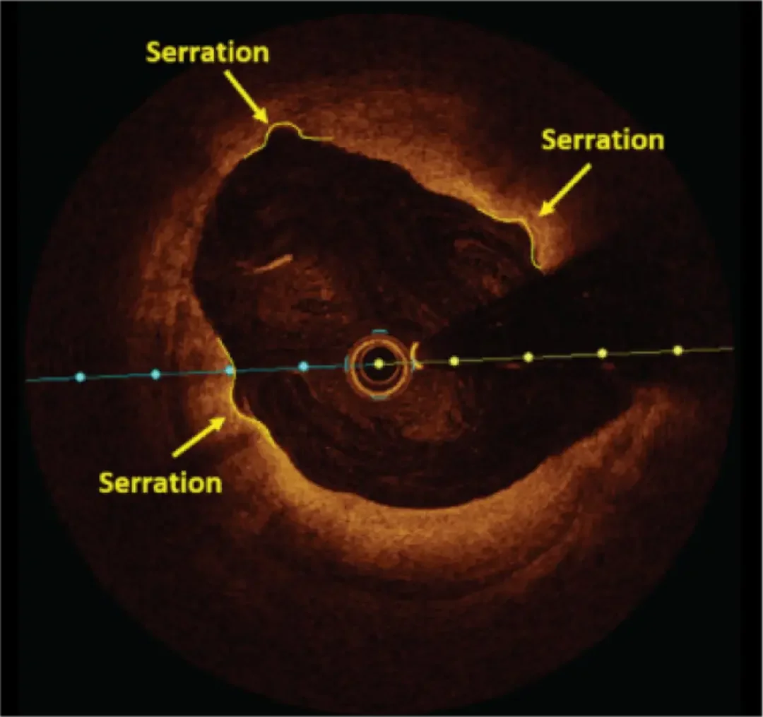 "OCT image showing serration evidence from Serranator device, per A. Holden MBChB FRANZCR EBIR
