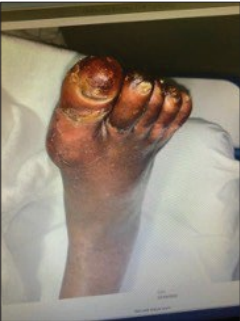 Clinical photograph showing nonhealing right foot ulceration with digital ischemia, Dr. Michael Siah patient case study