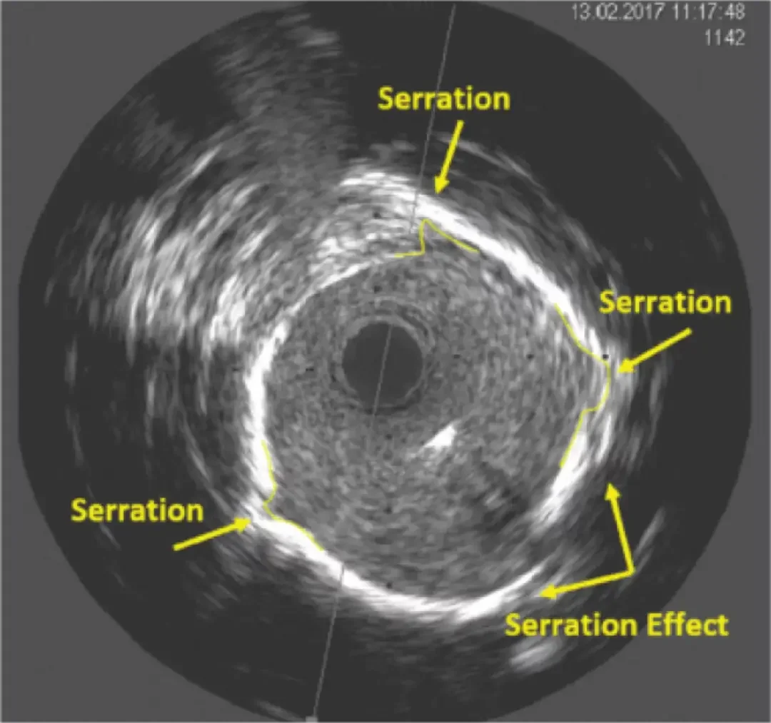 IVUS image showing controlled modification of calcified arterial layer with acute luminal gain from Serranator treatment