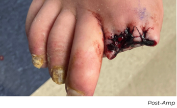 Clinical photograph showing post-amputation great toe wound in Patient D case study