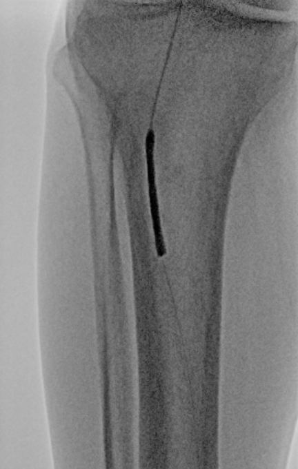 Angiographic image showing anterior tibial artery cannulation prior to Serranator angioplasty