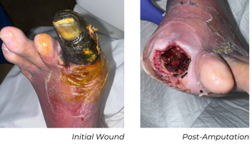 Clinical photographs showing initial toe wound and post-amputation site in CLTI patient case study (Patient A)
