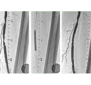Angiographic sequence showing left mid SFA lesion treated with Serranator, reducing stenosis from 77.02% to 12.84%