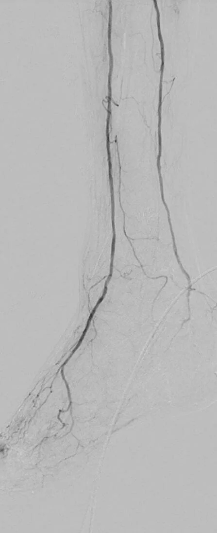Angiographic image showing completion angiogram with brisk two-vessel runoff and wound blush