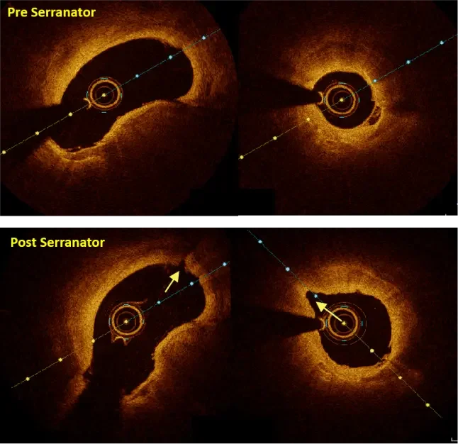 OCT images showing serrations created by Serranator device, performed by Dr. Andrew Holden