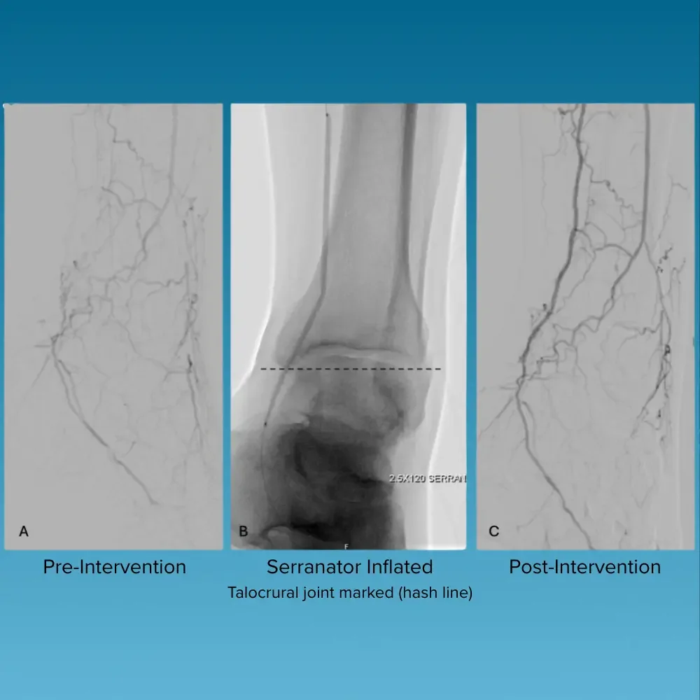 Pre- and post-intervention images of pedal artery revascularization using Serranator SL-PRO