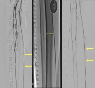 Angiographic images showing Proximal and Distal Posterior Tibial lesion with 80% stenosis treated with Serranator achieving 22% residual stenosis with no dissection