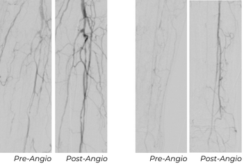Pre- and post-angiography images showing anterior tibial artery treated with Serranator and posterior tibial artery treated with POBA balloon in Patient A case study
