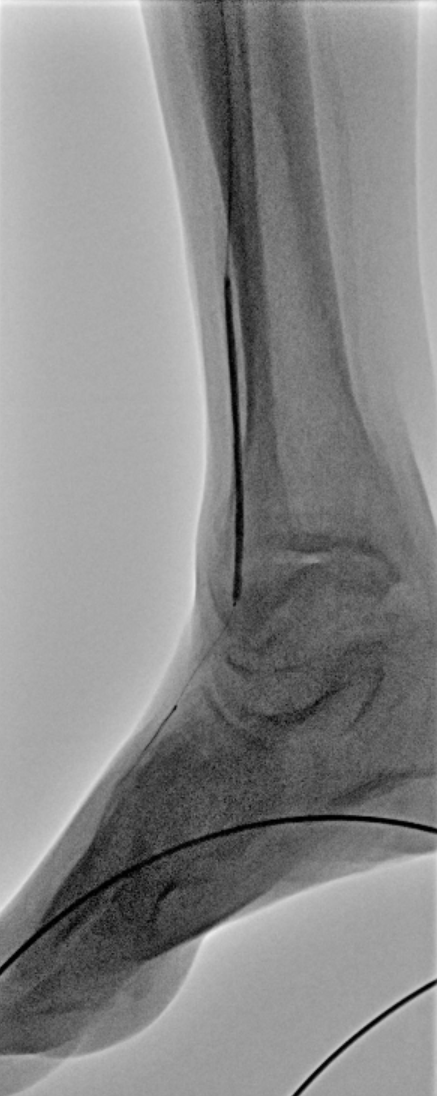 Angiographic image showing balloon angioplasty of calcified anterior tibial artery stenosis