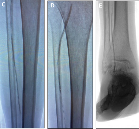 Angiographic images showing sequential Serranator balloon serration of tibial artery lesion and guidewire crossing of chronic total occlusion to dorsalis pedis artery