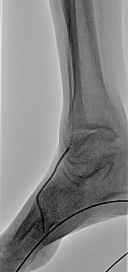 "Angiographic image showing Serranator treatment of distal anterior tibial artery and dorsalis pedis artery,