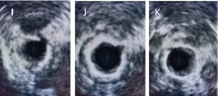 Intravascular OCT cross-section images showing vessel lumen pre- and post-Serranator angioplasty