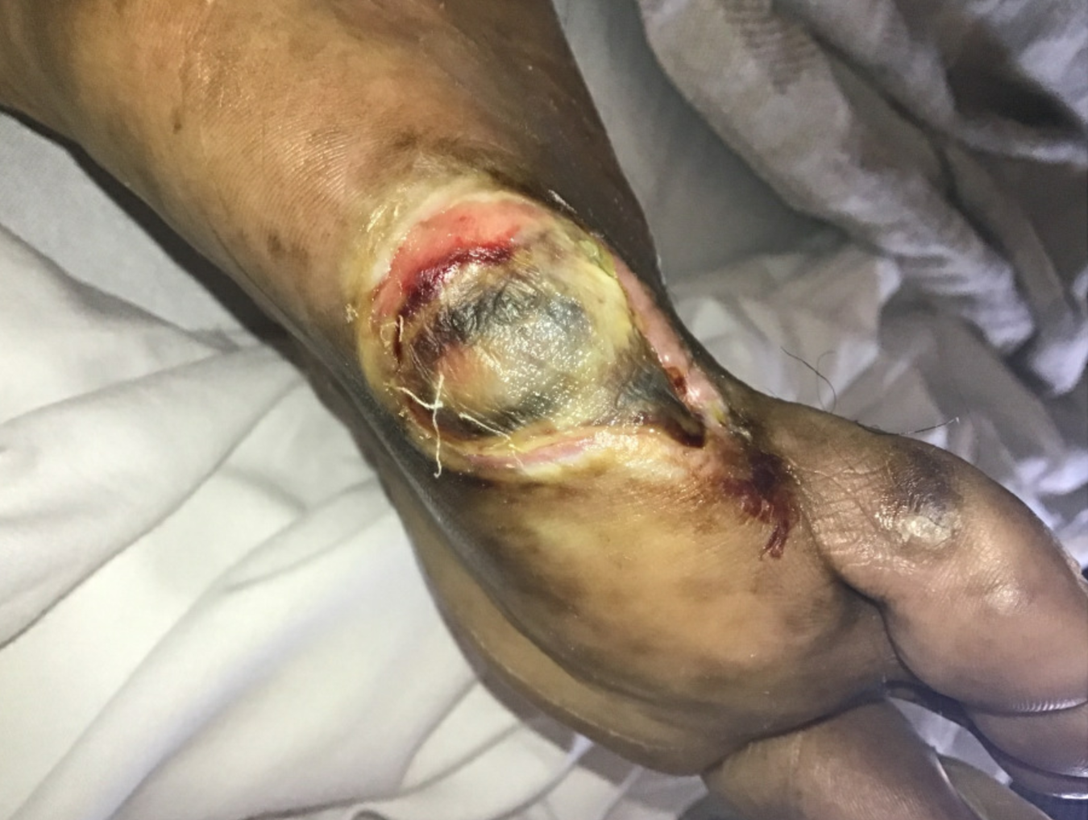 Clinical photograph showing gangrene of right fifth toe amputation site (Figure 1), per Dr. Bradley Trinidad case study