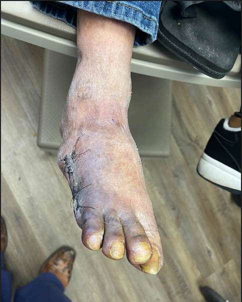 Clinical photograph showing healed fifth-toe ray amputation site one month after Serranator intervention, Figure 6, Dr. Bradley Trinidad case study