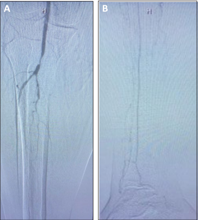 Angiographic images showing high-grade popliteal artery stenosis (Figure A) and severe tibial artery disease (Figure B), Dr. Michael Siah patient case study