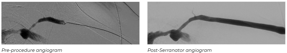 Angiographic images showing pre-procedure cephalic venous arch stenosis and post-Serranator angiogram with restored flow in AV fistula patient