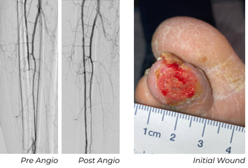 Angiographic and clinical images showing anterior tibial artery treatment and initial second-toe ulcer in Patient B case study